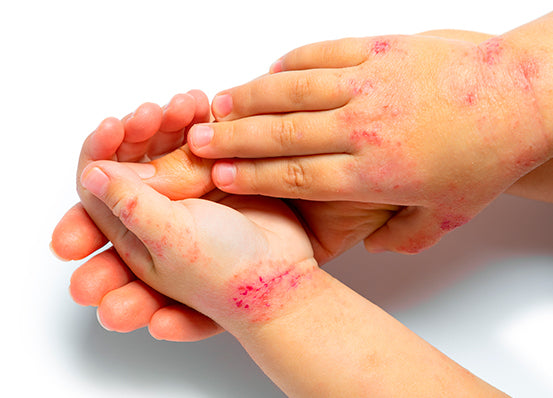Dermatitis Atópica- ¿Existe tratamiento? – Dermacross