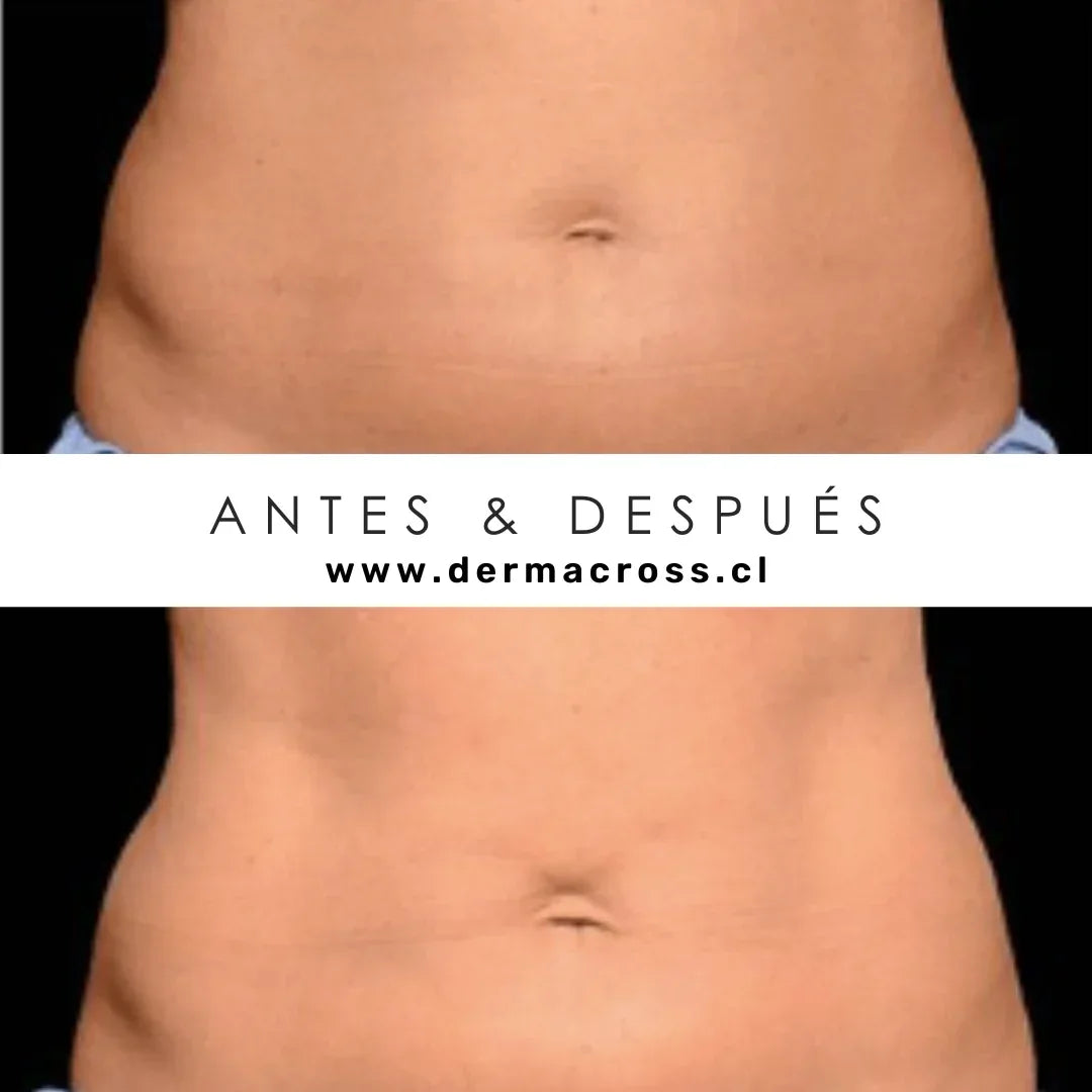 Coolsculpting
